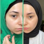voor en na foto van huidverbetering